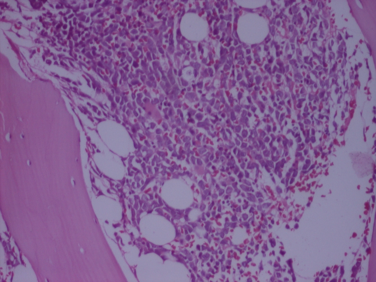 BM biopsy
